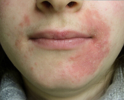 PERIORAL DERMATITT: Her er et illustrasjonsbilde som viser hvordan utslettet kan se ut. Foto: NTB Scanpix PERIORAL DERMATITT: Her er et illustrasjonsbilde som viser hvordan utslettet kan se ut. Foto: NTB Scanpix